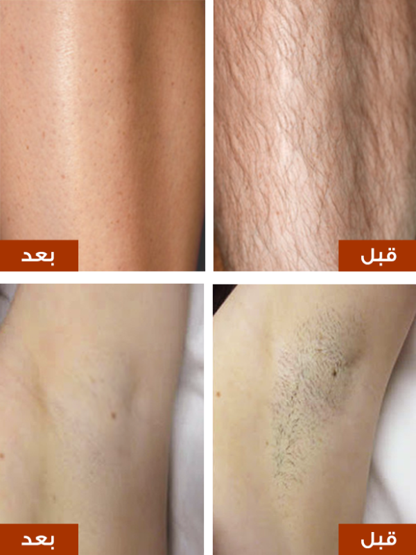 نتائج الليزر المنزلي